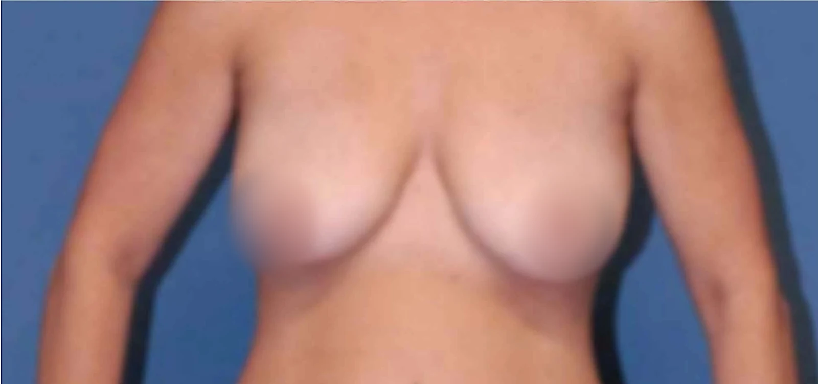 Before Breast augmentation silicon implant