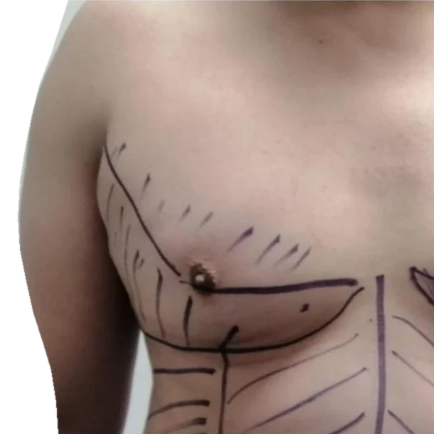 male gynaecomastia before surgery