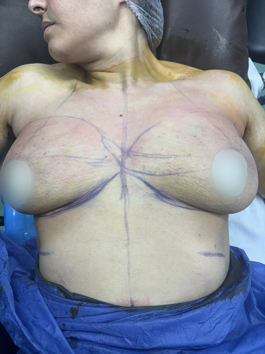 After Scar-less breast Laser-endolift