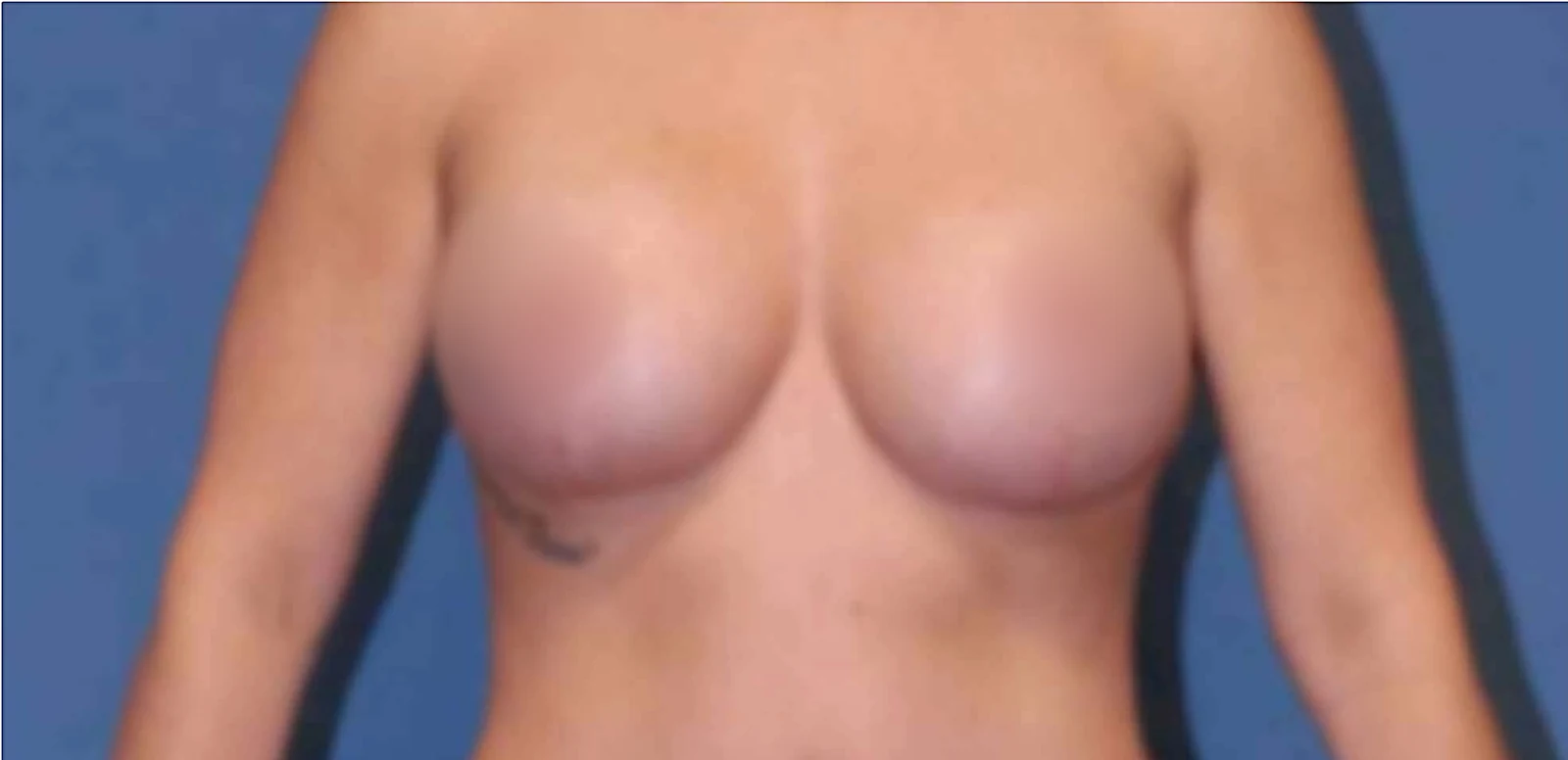 After Breast augmentation silicon implant