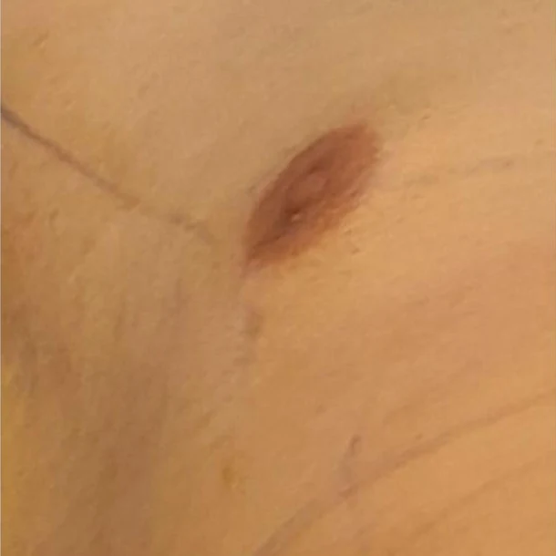 male defined breast after surgery